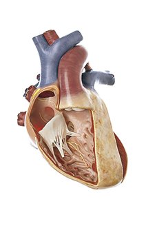 Transposition der grossen Gefässe mit Vorhof- und Ventrikelseptumdefekt