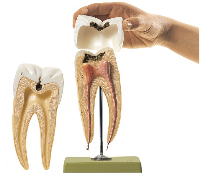 Dente molare con carie
