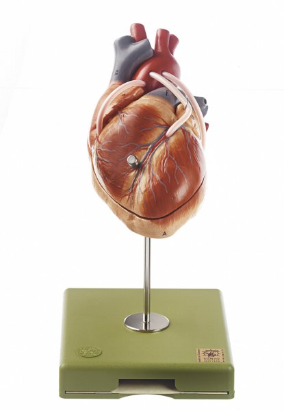 Modelo de corazón con vasos de bypass (bypass venoso aortocoronario)