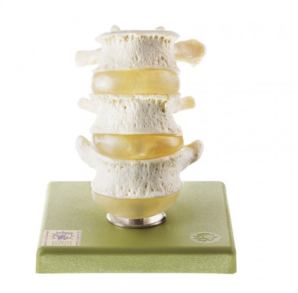 Three Lumbar Vertebrae with Discs