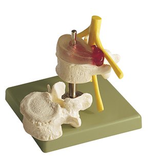 Hernia discal dorsolateral